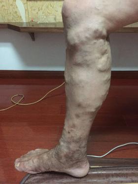 班长课堂090 | 静脉曲张案例一则