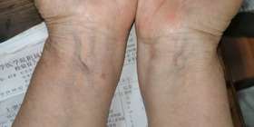 班长课堂042 | 冠心病手腕部指征