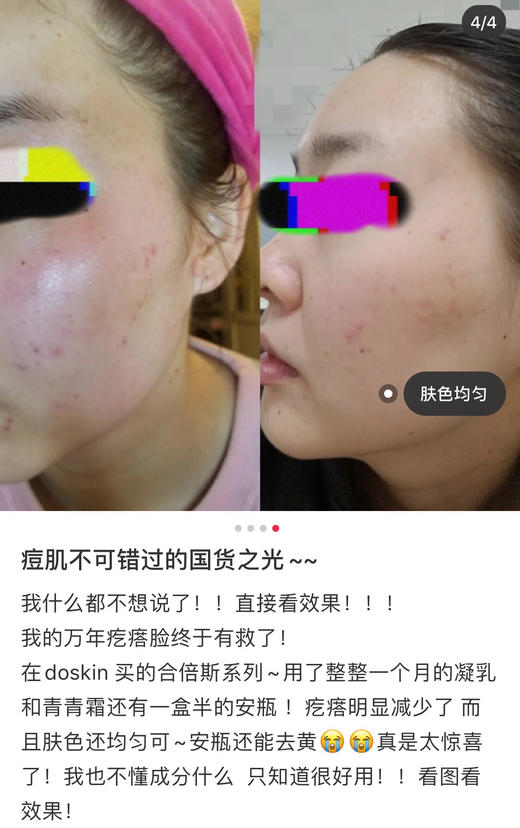 皮肤科推荐合倍斯----祛痘净澈安瓶液 痘痘肌的福星 商品图2