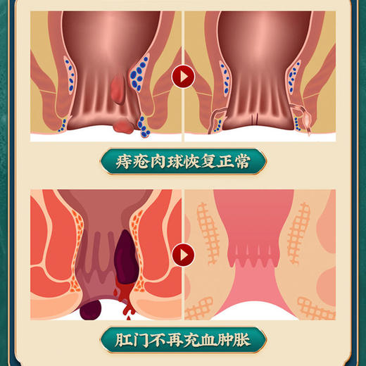 【买2送1，买3送2，买5送4】南京同仁堂痔疮灵老牌出品愈合痔疮裂口轻松5步解决保密发货 商品图2