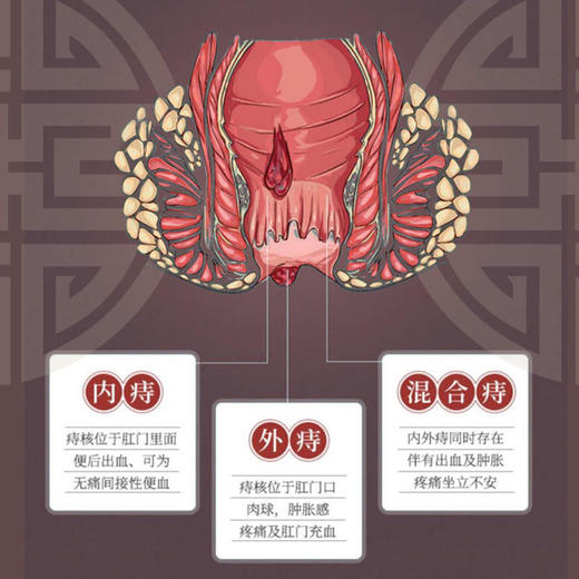 【买2送1，买3送2，买5送4】南京同仁堂痔疮灵老牌出品愈合痔疮裂口轻松5步解决保密发货 商品图1