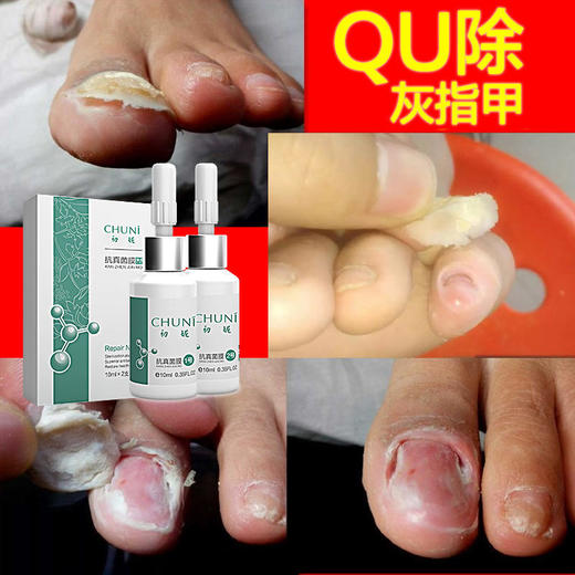 【灰指甲克星】初妮抗真菌膜复合型修复液中药萃取全新1+2复合技术深层渗透轻松告别老顽甲 商品图2