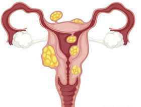 为什么子宫肌瘤切了，又长囊肿？