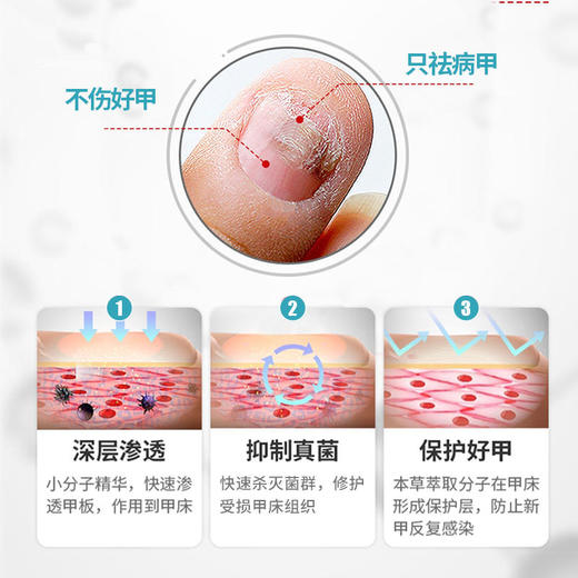 【买2送1买3送2买5送4】灰指甲液体敷料广药白云山出品实力祛灰甲植物配方温和不伤甲轻轻一抹灰甲变亮甲 商品图3