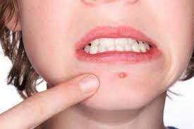  皮肤为什么总是反复长痘呢？这些原因，快来看看你是哪一种！ 