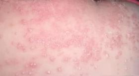 ▶湿疹难缠，受罪又毁皮肤！巧用一招，连根“拔掉”湿疹！ 