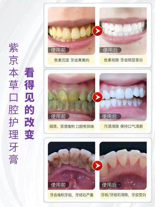 【买1送1 买2送2】抗敏感紫草牙膏hp去黄牙垢牙结石牙炎除口臭口气清新 商品图5