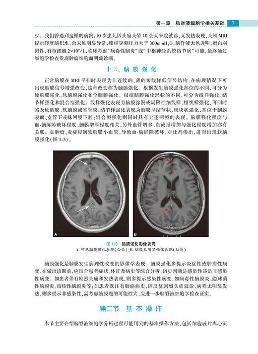 脑脊液细胞学图谱及临床诊断思路 许绍强 主编 脑脊液细胞学内科学书籍 图谱解读和案例分析 人民卫生出版社9787117313445 商品图4