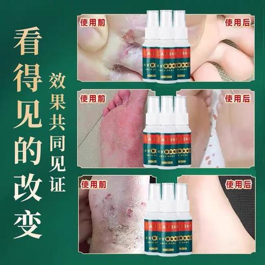 【买二送一】南京同仁堂腳气喷剂拖鞋不再尴尬去痒膏脱皮脚丫臭脚痒泡脚烂脚臭草本喷雾 商品图2