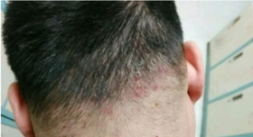  头痒、头屑多、头皮长痘痘？用它洗一洗，抑菌去屑，告别各种头发问题 