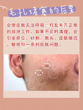 可怕！毛孔堵塞的后果！！