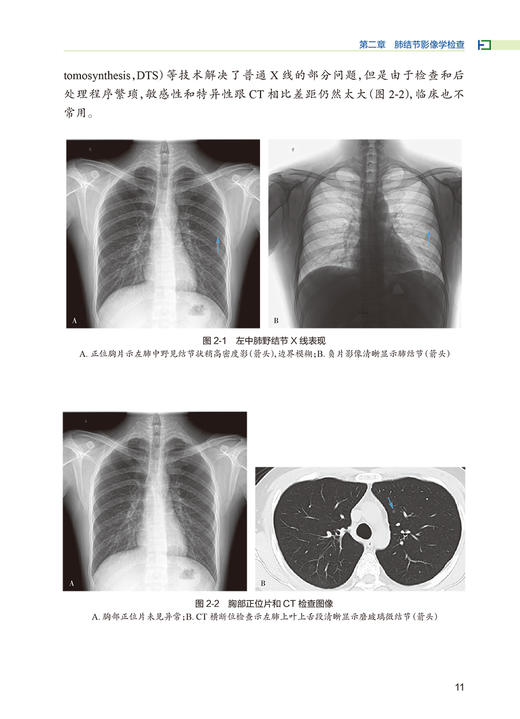 肺结节的CT诊断与介入治疗 纪建松 韦铁民 主编 计算机X线扫描体层摄影 临床医学书籍 碘图分析 人民卫生出版社9787117316552 商品图4