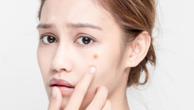 你是哪种痘痘？教你如何拯救你的痘痘肌