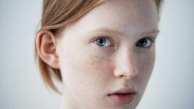 脸上的斑告诉我们什么？ 