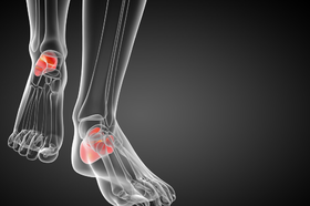  夏季尿酸不小心就升高？全是因为它！