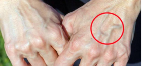 “青筋” 凸起，意味着什么?你知道吗？ 