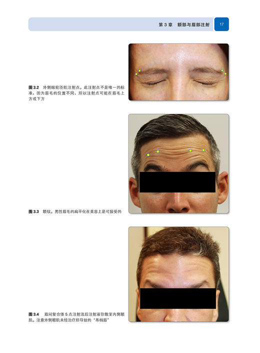肉毒毒素注射美容理论与实践手册 肯尼斯·R.比尔 整形美容医学书籍 A型肉毒毒素面部塑形紧致 辽宁科学技术出版社9787559120434 商品图4