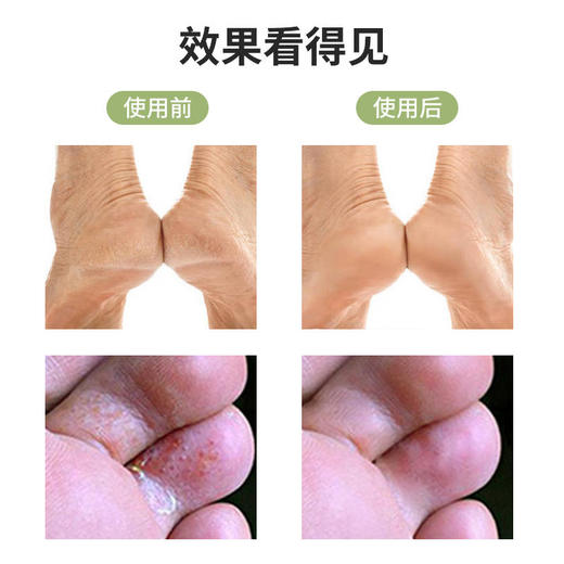 【买2送1 买3送2 买5送3】柏参足适爽保健喷剂植物配方告别脚臭足气脚干裂1瓶守护全家 商品图4