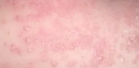 湿疹难缠，受罪又毁皮肤！巧用一招，连根“拔掉”湿疹！ 