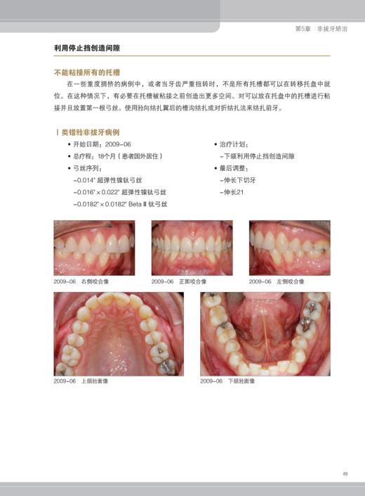 完美笑容背后的秘密 舌侧矫治器临床指南 第四版 徐宝华 口腔正畸学书籍 舌侧正畸治疗弓丝结扎 辽宁科学技术出版社9787559108210 商品图4