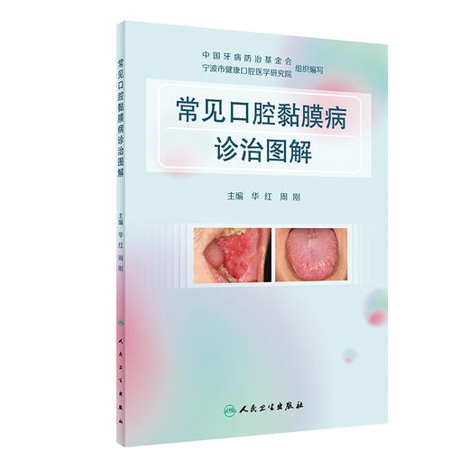 常见口腔黏膜病诊治图解 华红 周刚 口腔科学书籍 局部湿敷激光治疗 免疫调节药含漱剂涂剂用药 人民卫生出版社9787117317337 商品图0