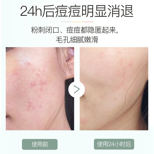 伊芳妮痘痘点涂棒修护敏感痘肌改善闭口粉刺淡化痘印水杨酸精华液七夕情人节 商品图1