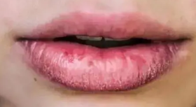 嘴唇干裂、咽喉肿痛、鼻子出血……送你这些“灭火”食疗方 