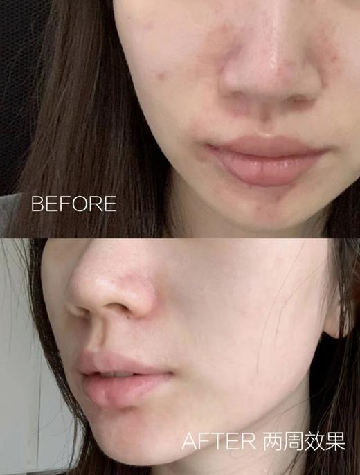 刮码介意勿下单！博乐达超分子水杨酸面膜100g（27.4.14） 商品图7