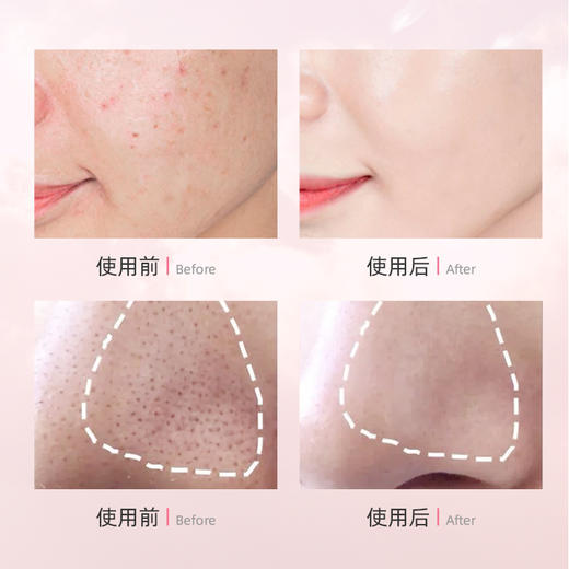 【买3送2】 HZ小泡敷氨基酸除螨洁面皂 多重植物精华 温和清洁控油拒绝螨虫脸 110g/盒 商品图1