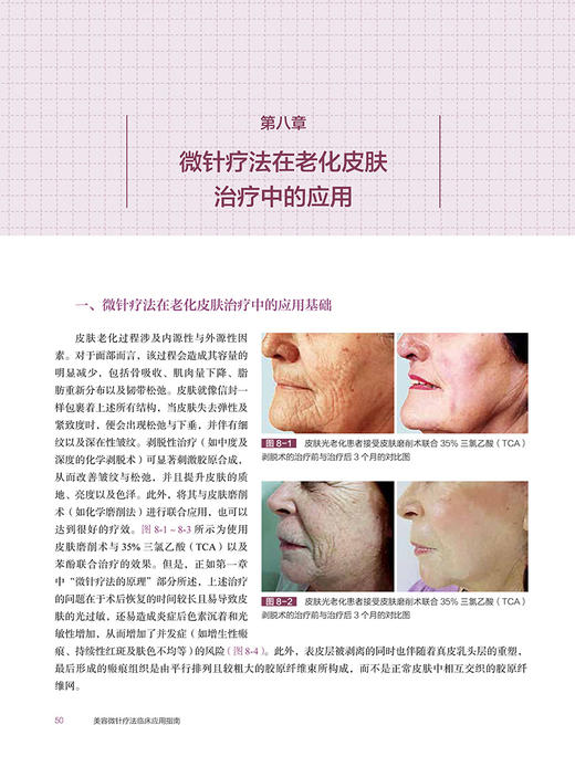 美容微针疗法临床应用指南 廖勇 译 美容医学书籍微整形 瘢痕皱纹皮肤松弛黄褐斑治疗皮肤科医师 北京大学医学出版社9787565924460 商品图4