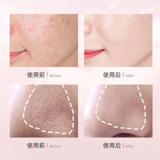 【买3送2】HZ小泡敷氨基酸除螨洁面皂多重植物精华温和清洁控油拒绝螨虫脸110g/盒 商品图1