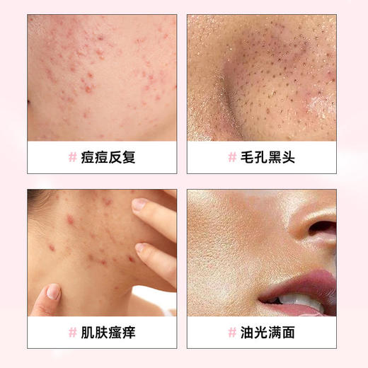 【买3送2】HZ小泡敷氨基酸除螨洁面皂多重植物精华温和清洁控油拒绝螨虫脸110g/盒 商品图3