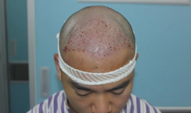  头发竟然都长出来了！后退的发际线，真的还可以再救一下！ 