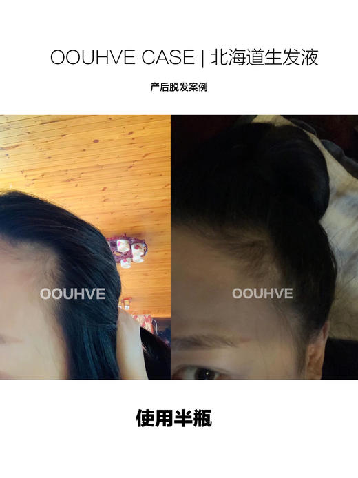 5折清仓(8月到期，不开封可延长2年)头皮抗老产后脱发拯救发际线日进口北海道生发液头皮护理精华增长睫毛眉毛20ml 商品图6