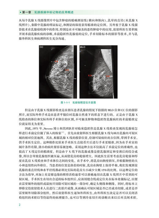 组织标记在乳腺疾病精准诊疗中的应用 包含了影像学组织标记在乳腺疾病中的筛查 刘强 龚畅 主编9787117317306人民卫生出版社 商品图4