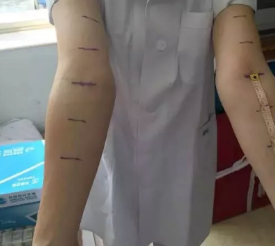  专家 | 王翔教授：术后必备！淋巴水肿应该如何预防及处理？ 