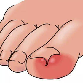 甲沟炎居然上了热搜？疼起来要命该怎样正确处理？