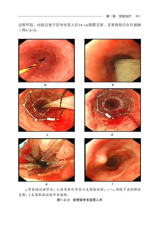 消化内镜治疗学典型病例图谱 陈磊 等编 超声影像医学书籍超声内镜消化系统疾病诊断和治疗 科学技术文献出版社9787518980208 商品图3