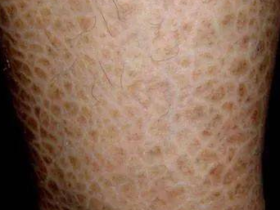 脚后跟干裂,小腿长“鱼鳞”,你以为皮肤缺水？ 错，病根在这里！ 