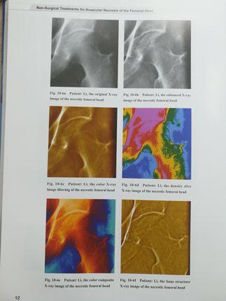 Non-Surgical Treatments for Avascular Necrosis of the Femoral Head （英文版）黄克勤 主编 中国中医药出版社 书籍 商品图4