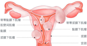 子宫肌瘤、甲状腺结节、乳腺增生、痛经，大多是痰瘀互结惹的祸！