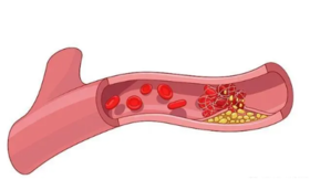 世界血栓日丨别让血栓堵住了你的生命！ 