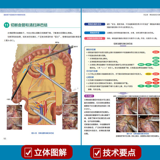 腹腔镜下结肠癌手术的策略和实践 商品图2