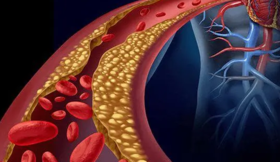保持血管畅通，远离臭名昭著的血栓杀手 