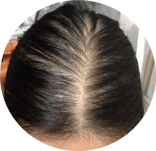 休止期脱发.png 休止期脱发.png