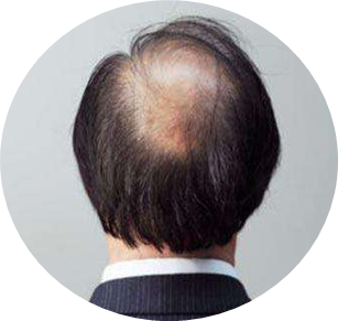 雄激素脱发.png 雄激素脱发.png