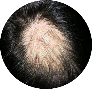 斑秃.png 斑秃.png