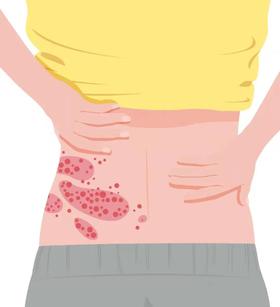 “不死的癌症”带状疱疹终于有“克星”了！你关心的问题都在这里