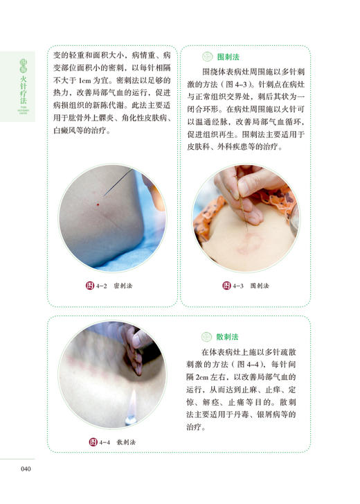 图解火针疗法 第二版 中医适宜技术操作入门丛书 李岩 周震 贺小靖 中医学书籍中医针灸学 中国医药科技出版社9787521426670 商品图4