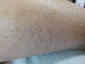 一到冬天，全身皮肤发痒又掉屑？原来是这么回事儿！ 